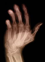 arthritis-hand.jpg